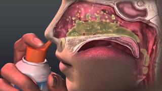 Can Saline Irrigation Help Nasal Allergies Animated Guide to Saline Nasal Irrigation [upl. by Yclek146]