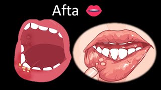 👄 Aftas  Cavidad oral  Cabeza y Cuello  Patología [upl. by Perri556]