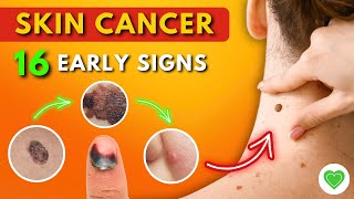 16 Early Signs of Skin Cancer You Should Never Ignore  Melanoma  Skin Cancer Symptoms [upl. by Wilhelmina]