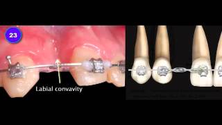 V5 iAOI Case 5 Report by Dr Lee Congenital Missing Teeth with a Unilateral Crossbite [upl. by Anitan]