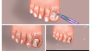 ASMR ingrowth toe nail removalcleaning dirty nails Toenail cleaning [upl. by Jair884]