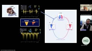 Right Ventricular Injury Patterns in Critical Care Cases [upl. by Aicrag]