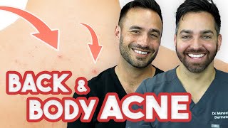 BACK ACNE  How to Treat and Prevent It  Doctorly Routines [upl. by Donoghue]