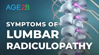 What Are the Symptoms of Lumbar Radiculopathy  Spinal Nerve Root Pain  Disc Bulge [upl. by Essirehc]