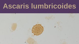 Ascaris Lumbricoides and Ascariasis  Pathology mini tutorial [upl. by Giovanni]