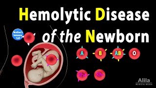 Hemolytic Disease of the Newborn HDN Animation [upl. by Sonitnatsnoc]