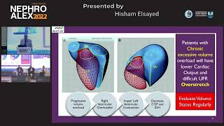 Hisham El Saied IV albumin for intradialytic hypotension [upl. by Anirahs913]