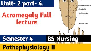 Acromegaly  Growth Hormone Signs amp Symptoms Diagnosis Treatment  Pathophysiology 2 in Urdu [upl. by Haymo]