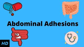 Abdominal Adhesions Causes Signs and Symptoms Diagnosis and Treatment [upl. by Ponzo]