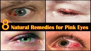 How to Get Rid of Pink Eye Fast at Home  8 Home Remedies for Eye Infection [upl. by Tebor475]