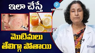 Best treatment for Pimples  Acne explained by Dr Chandravathi Dermatologist  Telugu Popular TV [upl. by Dorion402]