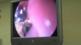 Endoscopy Removal of Swallowed Sock from Puppys Stomach [upl. by Azyl]