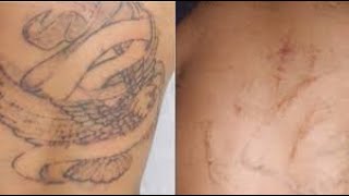 Dermabrasion Still Effective Still Valid For Tattoo Removal [upl. by Jania775]