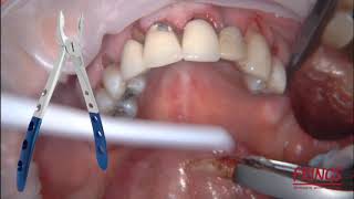 Atraumatic Extraction using FRINGS® [upl. by Fabozzi]