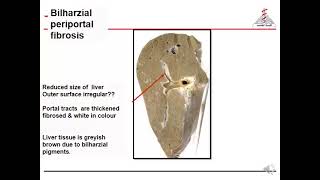 Infectious module  pathology parasitic intestine Bilharziasis part 2 [upl. by Lark]