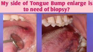 Tongue bump pain swelling irritationMy Side of Tongue papillae enlarge is to need of biopsyTongue [upl. by Roberto]