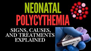 Neonatal Polycythemia Signs Causes and Treatments Explained [upl. by Ytissac]