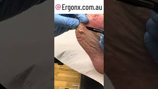 Thick painful forefoot callus removal by podiatrist undefined [upl. by Patric]