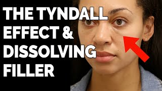 Dissolving Filler The Tyndall Effect and EyeGlow® with Dr Shirazi [upl. by Nayd844]