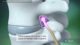 Lumbar Radiculopathy Reasons [upl. by Hallvard]