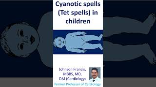 Cyanotic spells Tet spells in children [upl. by Martijn]