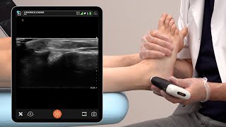 Ultrasound of the Lateral Ankle Ligaments [upl. by Elyr]