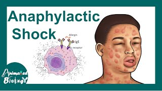 Anaphylactic shock  Anaphylactic Reaction Symptoms and Treatment [upl. by Riki419]