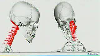 ¿Qué es la tortícolis y cómo tratarla [upl. by Henning]