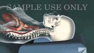 Cervical Chiropractic Adjustment [upl. by Fleta]