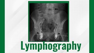 Lymphography Lymphangiography Techniques And Uses Lymphangiogram Purpose Procedure And Risks [upl. by Mooney]