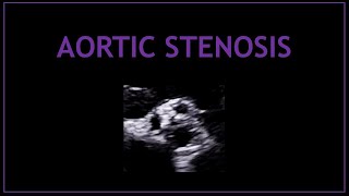 Aortic Stenosis Echocardiography  Cardiology [upl. by Dareg]