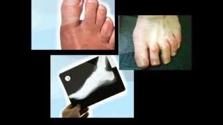 How to Fix Hammer Toe On Children [upl. by Ariadne]