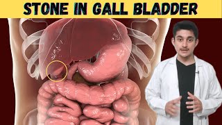 What are Gallstones 3d animation  pain symptoms causes  cholesterol bilirubin  kya kyu hai hindi [upl. by Neerol540]