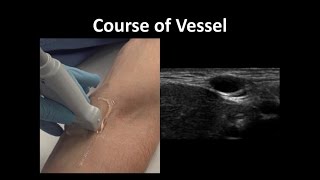 UltrasoundGuided Peripheral Vascular Access  BAVLS [upl. by Relyuc867]