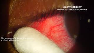 Eyelash impaction in lacrimal punctum [upl. by Acinemod601]