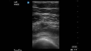 Knee Ultrasound Suprapatellar Bursa No effusion Part 1 [upl. by Faustus]