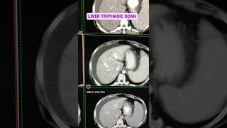 Liver Traphasic shorts radiology ytshorts [upl. by Leasa276]