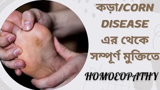 CORN DISEASE  কড়া  গুফো এর সমস্যার সম্পূর্ণ নিরাময়ের জন্য HOMEOPATHIC MEDICINES [upl. by Annaehs]