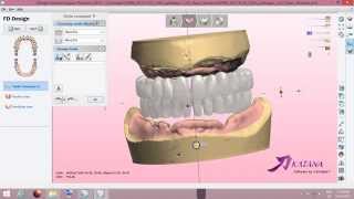 Digital Full Denture Design [upl. by Yrok]