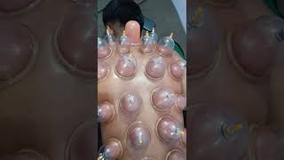 Cupping therapy for back pain backpain sciatica lowerbackpain cupping physiotherapy love [upl. by Stein801]