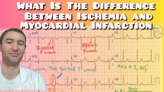 Myocardial Infarction vs Ischemia Whats the Difference [upl. by Ennaecarg]