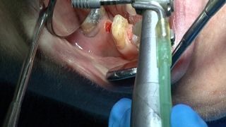 Implantes endodoncia coronas  Odontologia Multidisciplinar Dentistry Multidisciplinary [upl. by Aihcrop881]