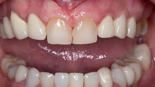 Gum retraction  preparation of Teeth for veneers  preparation of Teeth for crowns [upl. by Ygiaf]