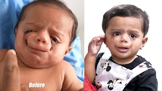 One in A Million Type Super Rare Birth Defect Baby  6 Months After Surgery [upl. by Nej224]