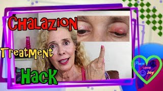 Chalazion Treatment Hack [upl. by Anikahs868]