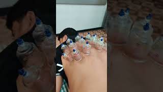 upper back pain cupping therapy bestphysiotherapycenter [upl. by Launamme]