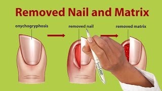 Nail Removal Treatment for Onychogryphosis [upl. by Map]