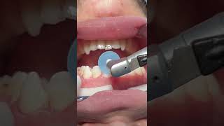 Composite restoration for anterior teeth satisfying [upl. by Villiers]