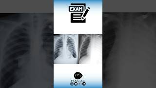 Epanchement pleural VS Pneumothorax  Exam [upl. by Ddet]