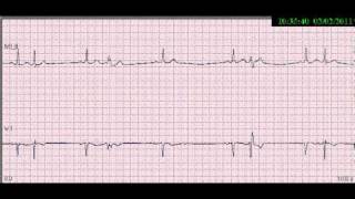 05EKGCOMPLEXO ATRIAL PREMATURO [upl. by Gilus]